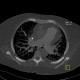 CTEPH, chronic thromboembolic pulmonary arterial hypertension, MIP: CT - Computed tomography